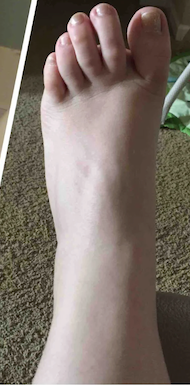 Postpartum swelling after
