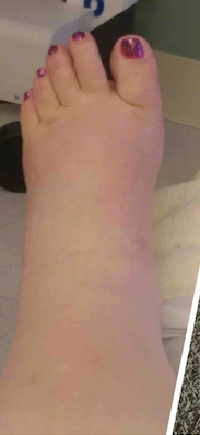 Postpartum swelling before